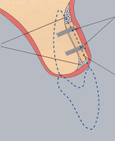 骨補填材